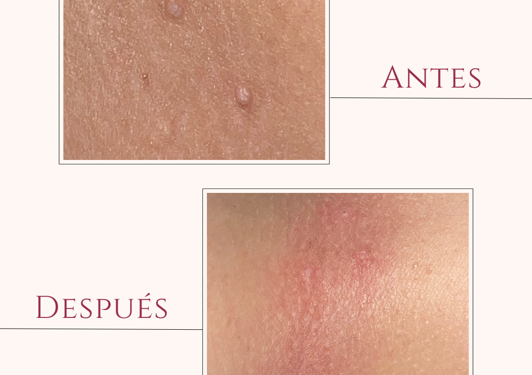 Remoción de Skin Tags