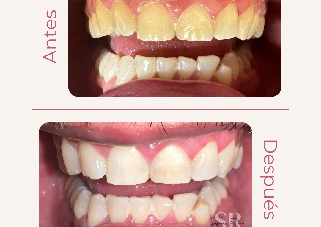 Blanqueamiento Dental