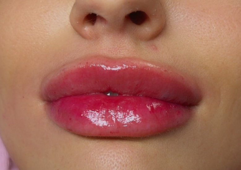 Micro Needle/Hyluran pen Lip Filler (2 ML)