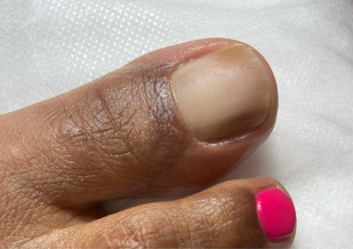 Ekstra avgift ved prosedyre hvis tær negler er ikke frisk