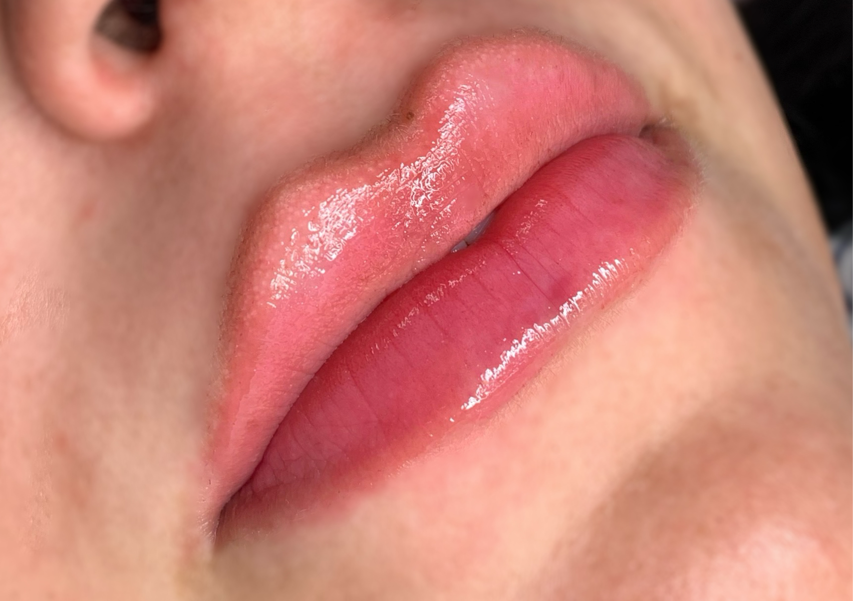 Aumento + Hidratación Labial 