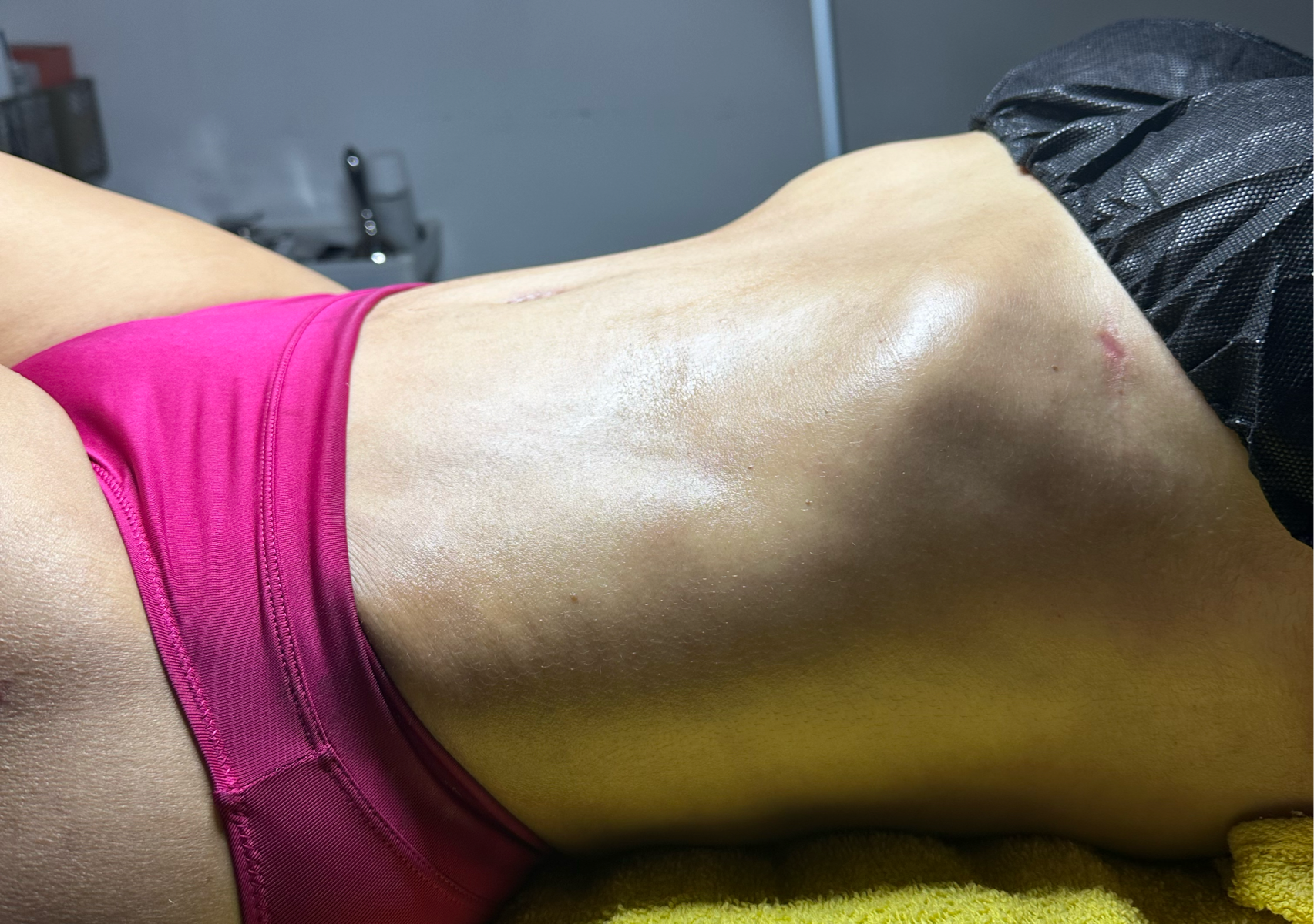 Paquete Masajes Post Operatorio (10 Sesiones)