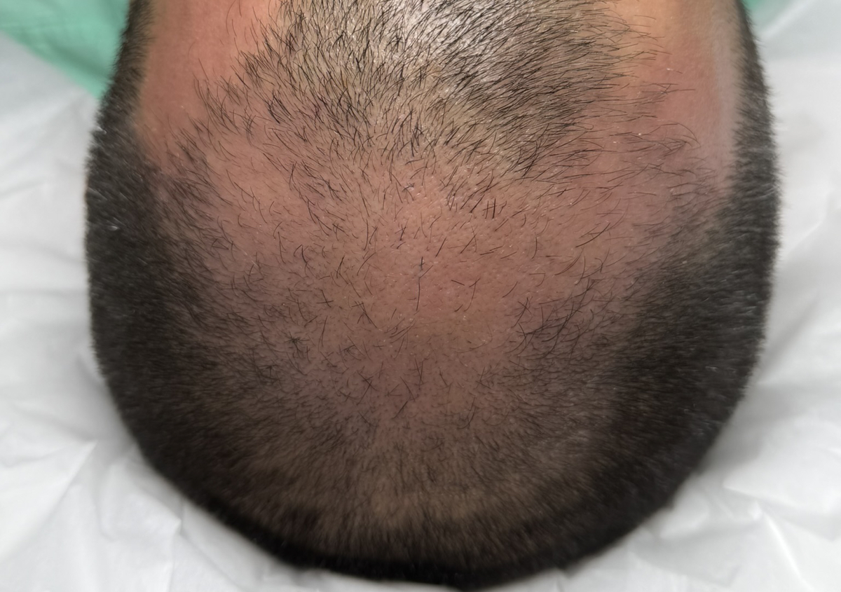 Estimulación Capilar 