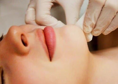 Depilación de Mentón