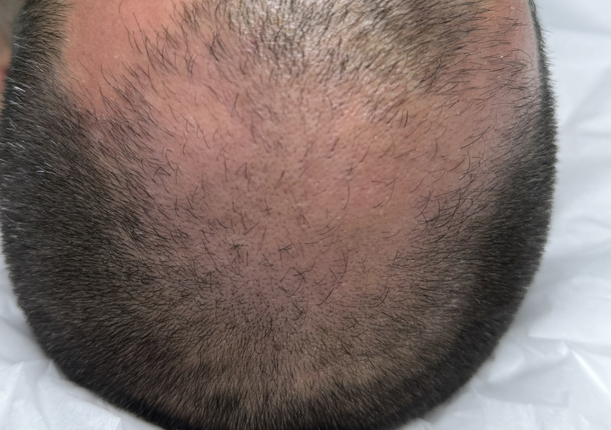 Evaluacion Crecimiento Capilar