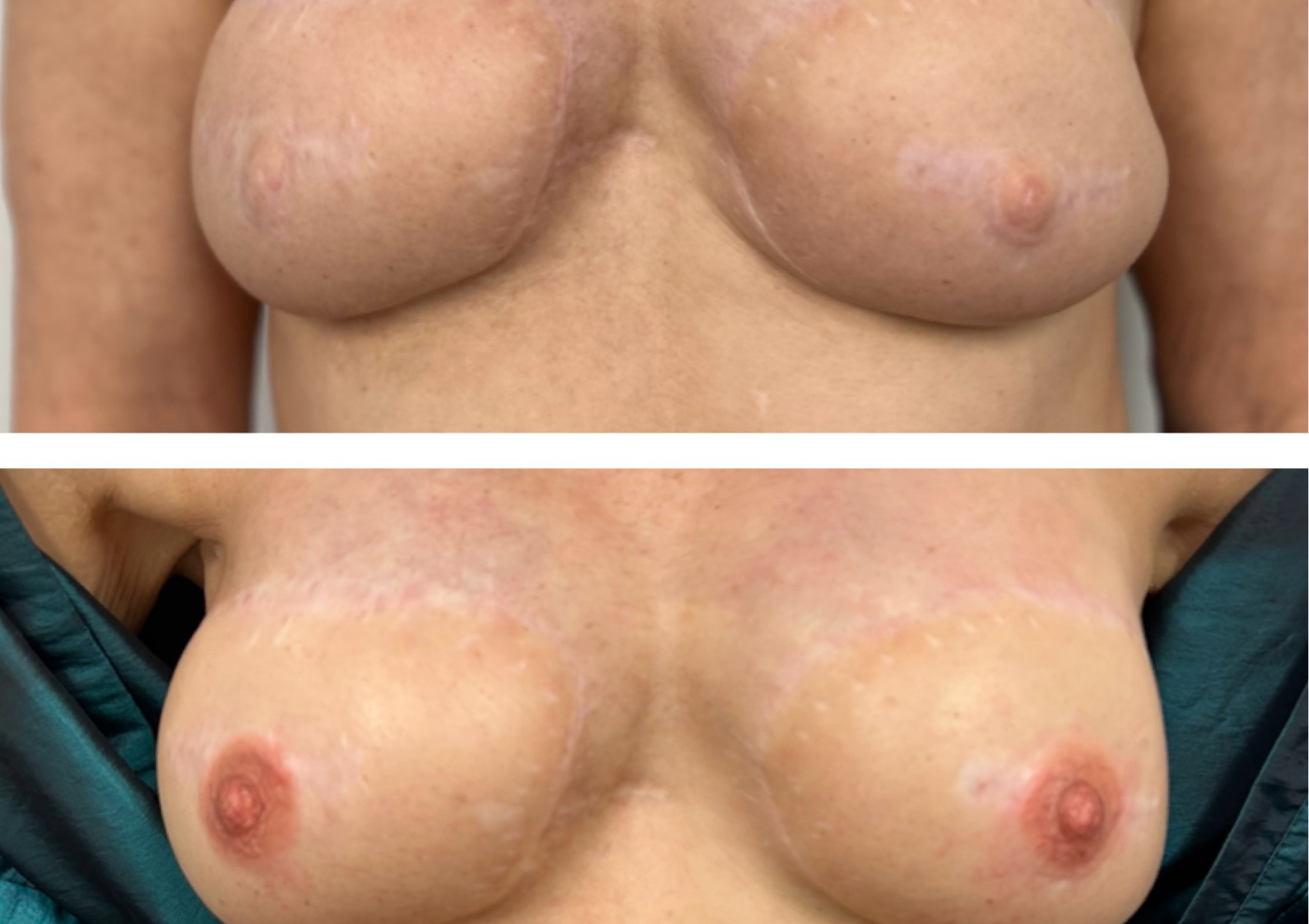 Consult - Areola Tattoos