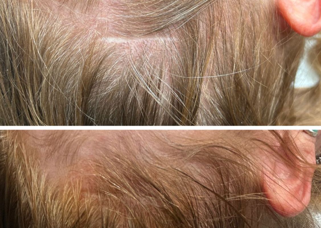Consult - Scalp Scar Camouflage