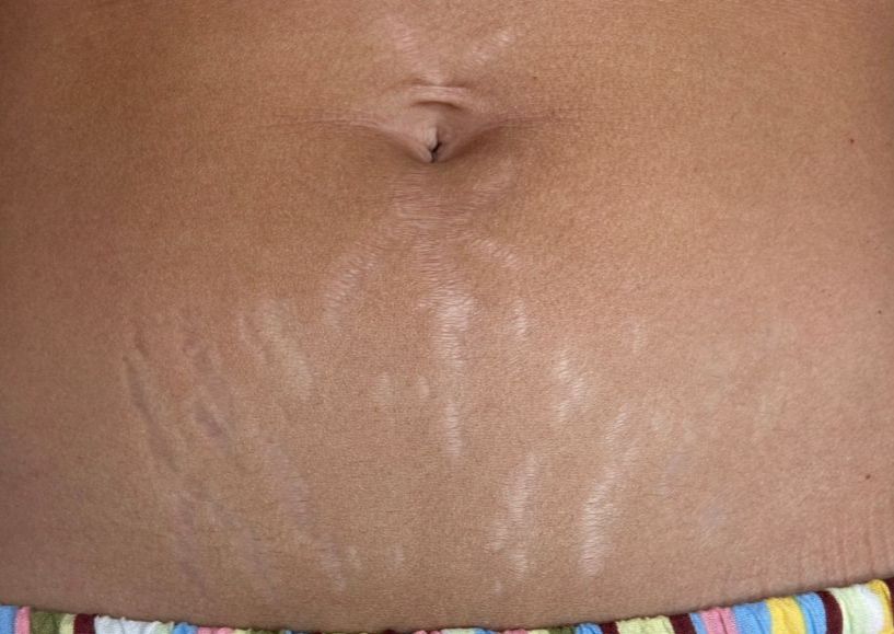 Consult - Stretch Mark Revision