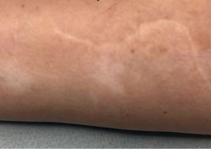 Consult - Inkless Scar Revision
