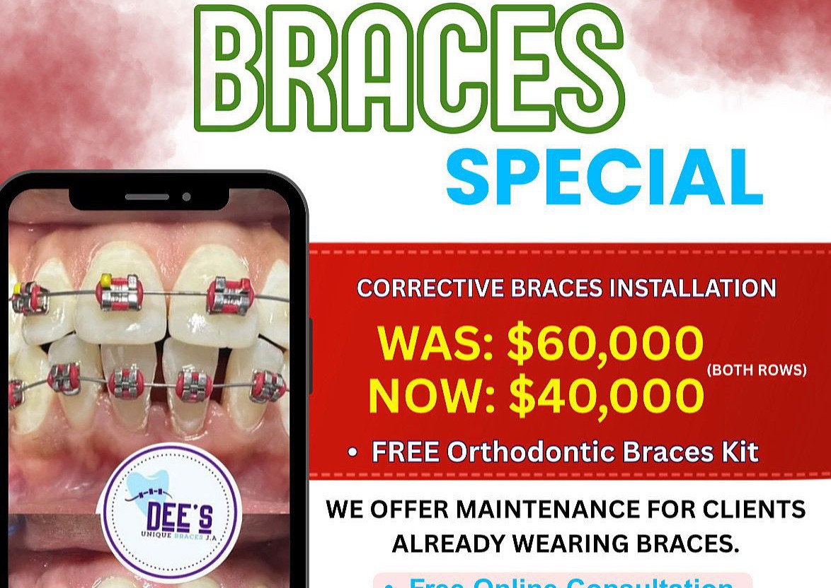  Authentic Braces Installation ( Both Rows )
