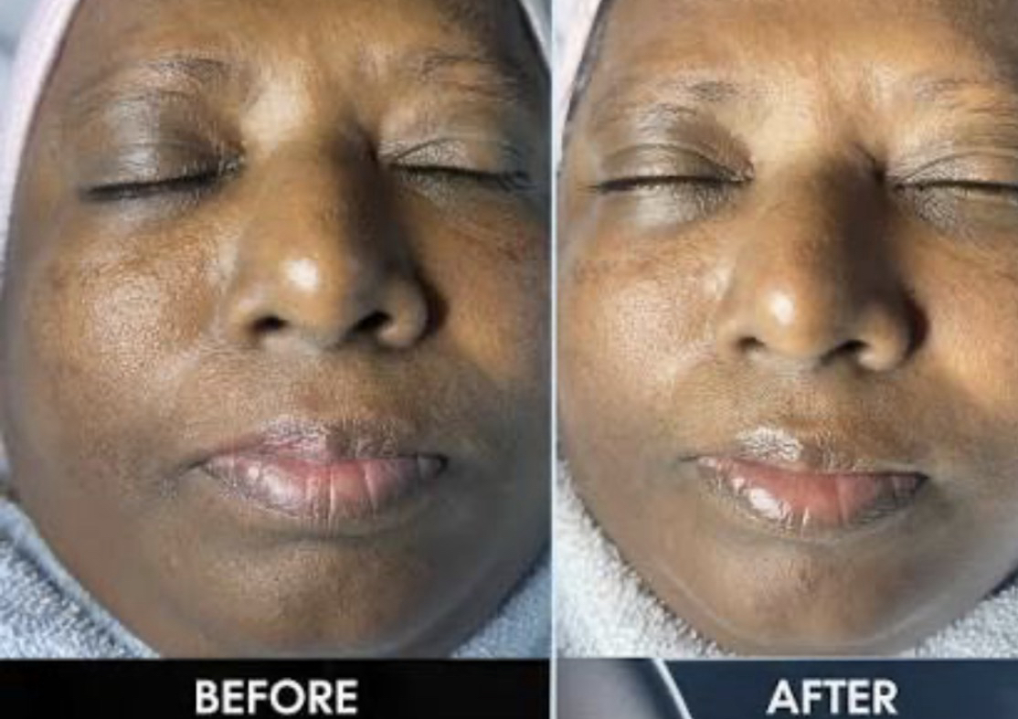 Microdermabrasion 