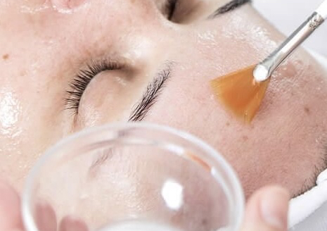 Peeling químico ( Chemical Peel) 