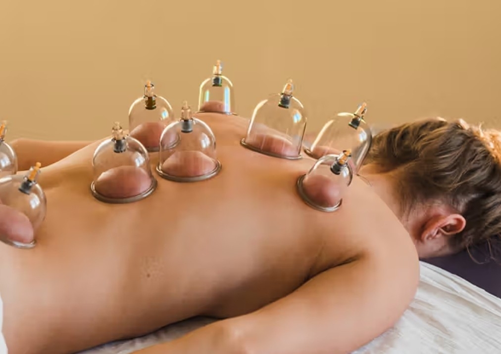 Cupping - Females Only