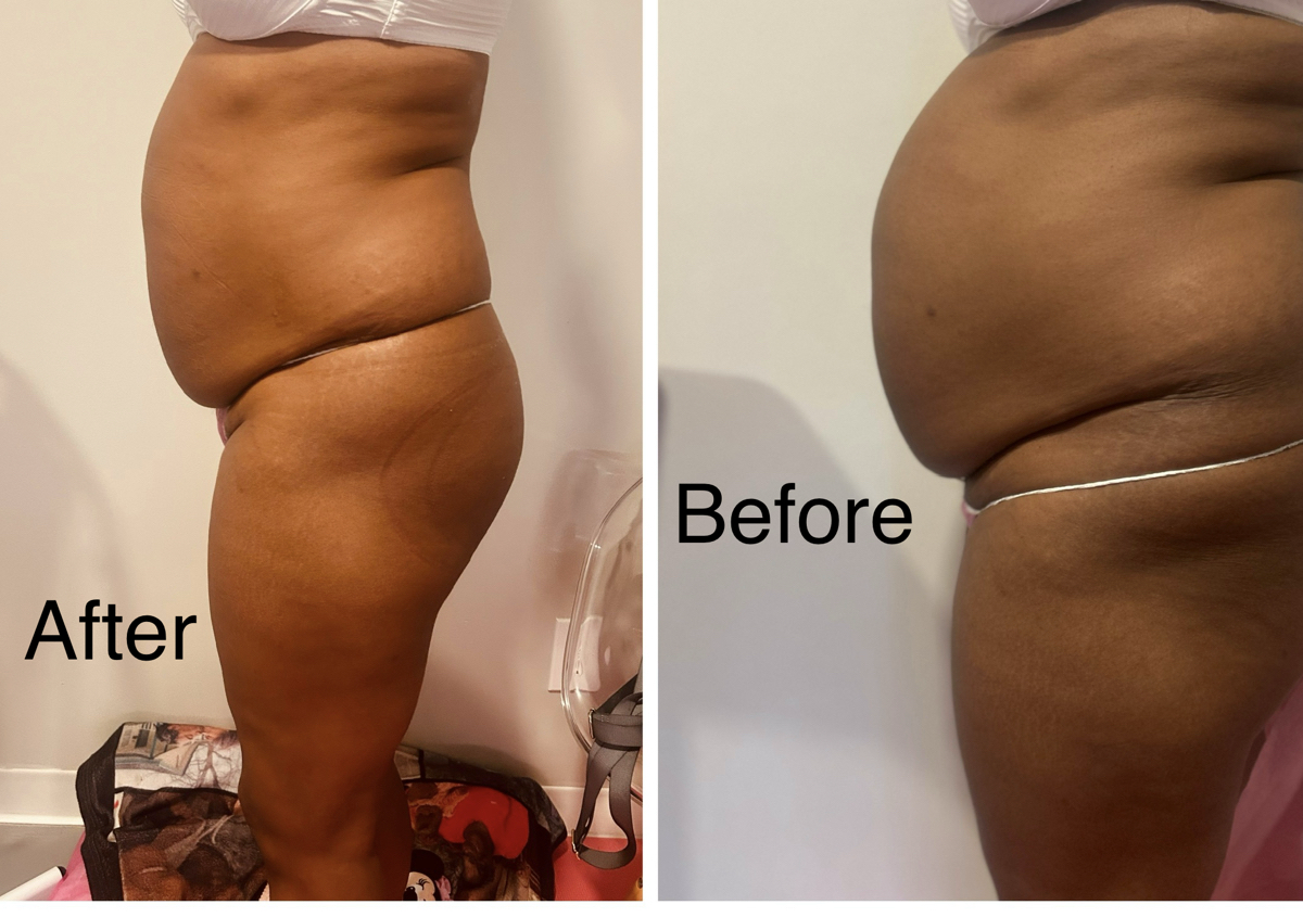 Ultrasonic Cavitation