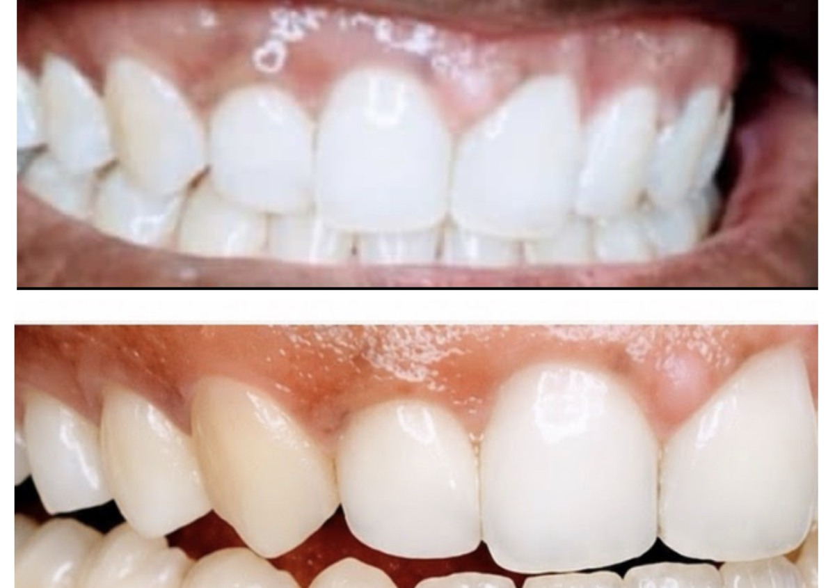 Teeth Whitening Sparkly Whites
