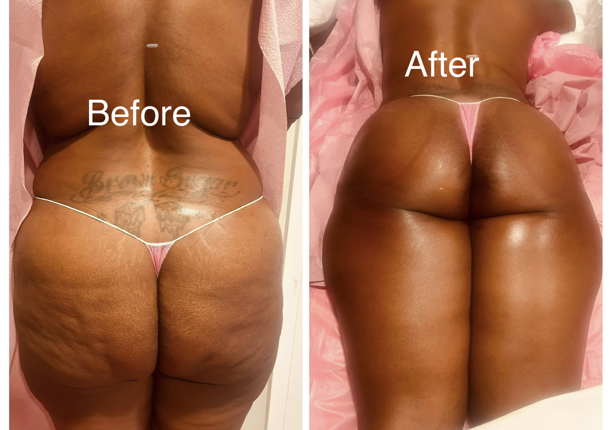 Vacuum Butt Therapy 