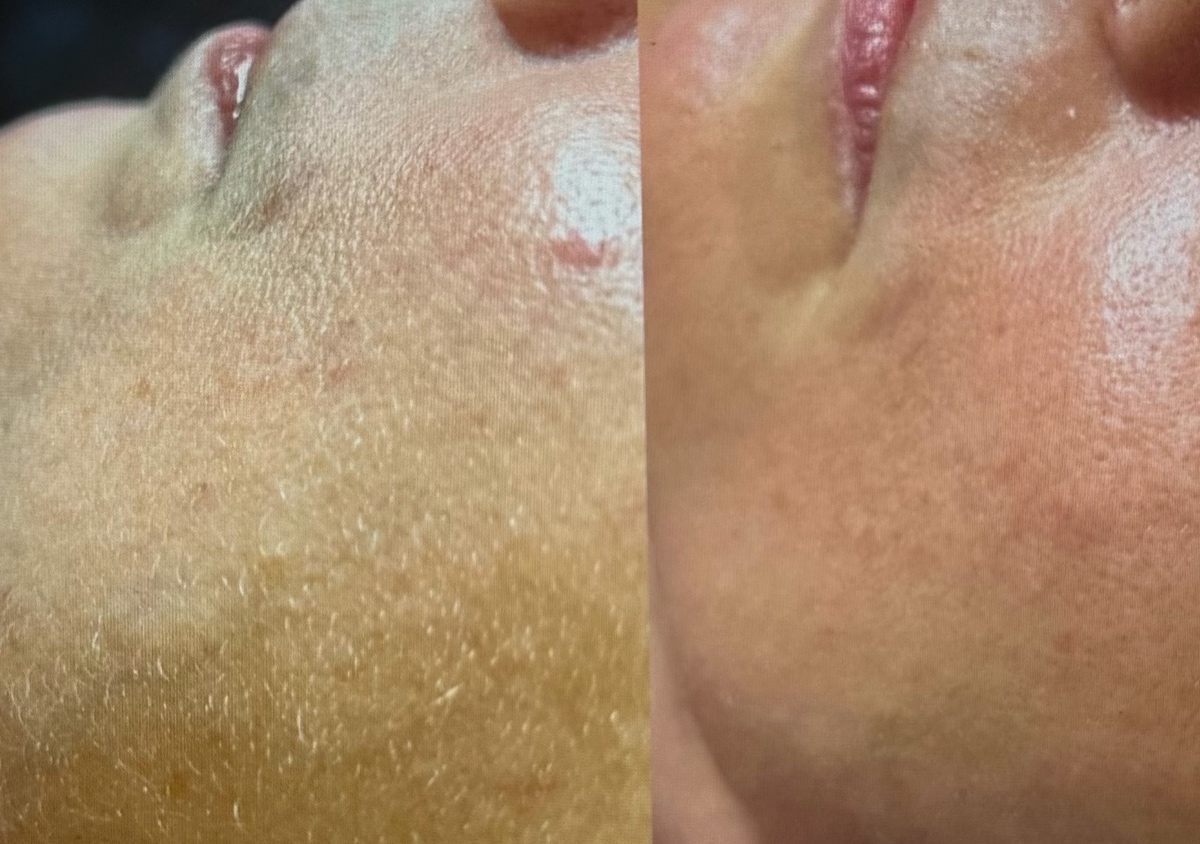 Package of -3 Signature Dermaplaning Facial