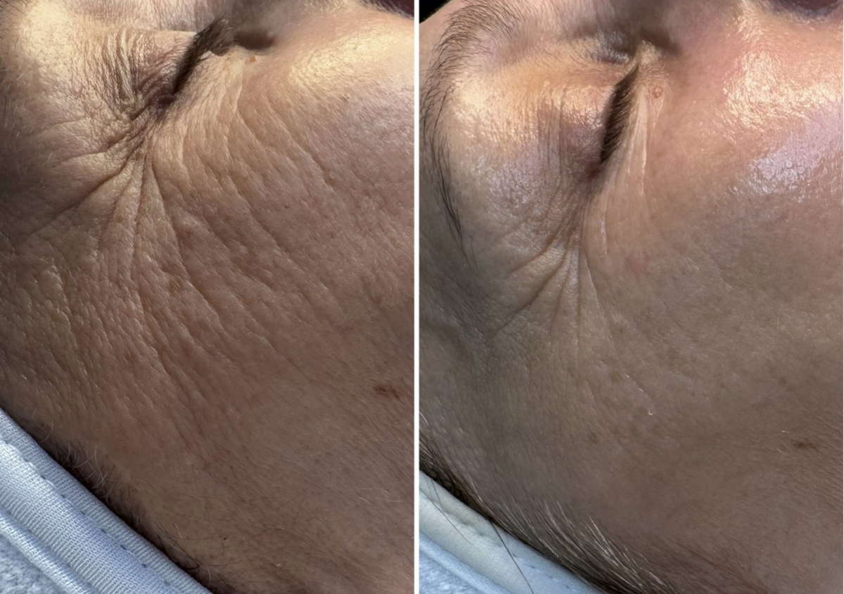 Package of - 3 Lume Timeless Lift Facial
