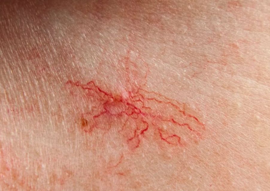 Thermavein removal - Single vessel (autumn and winter time !!!)