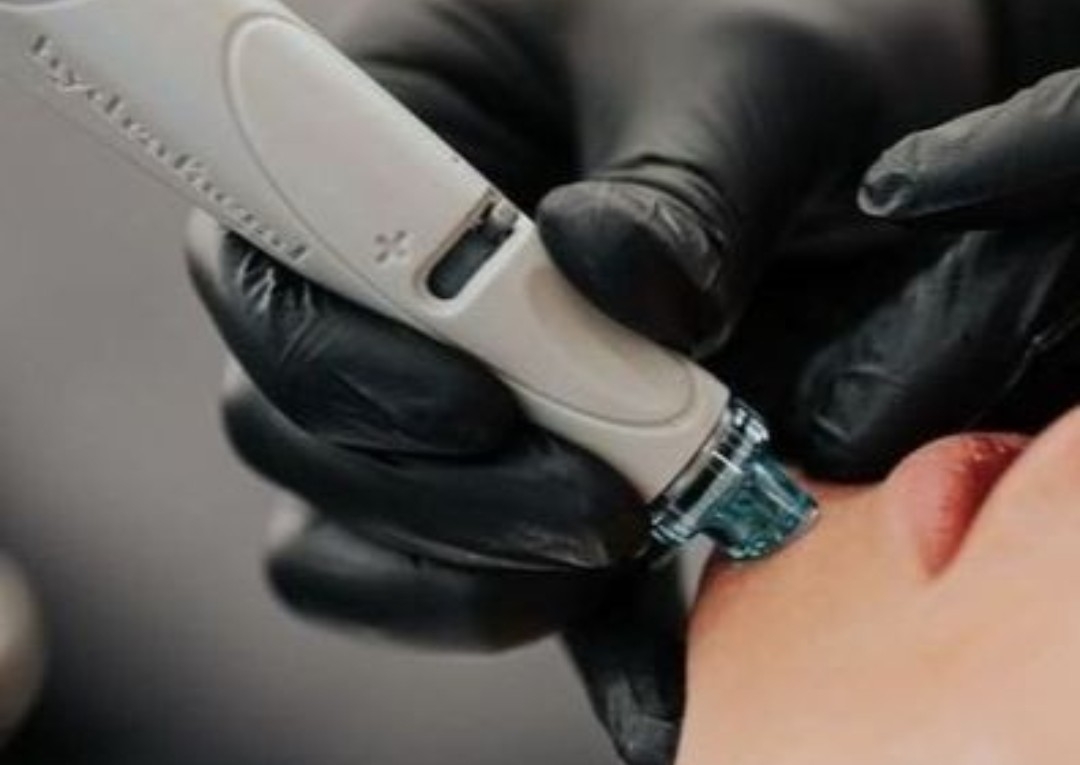 HydraFacial (Hydrabrasion+ Radio frequency (RF)+hf