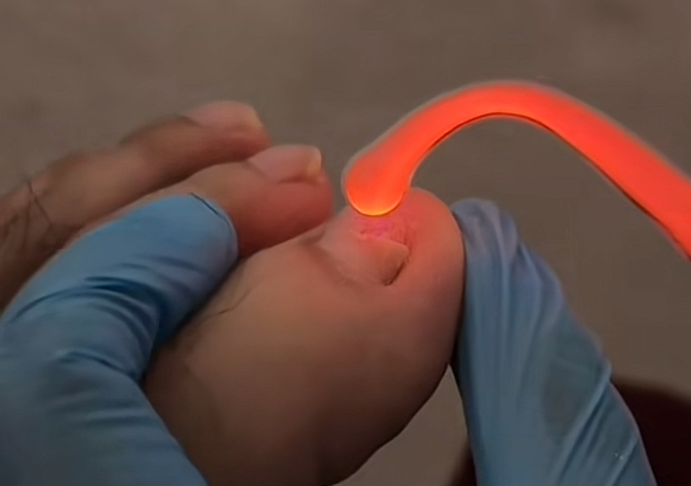 Alta frecuencia (Uñas enfermas)