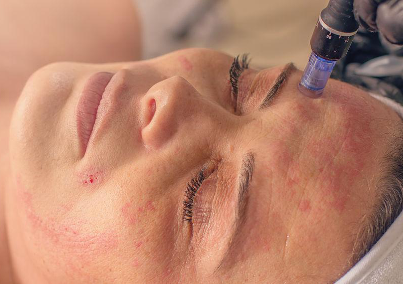 Microneedling with skin Specific   cocktail 