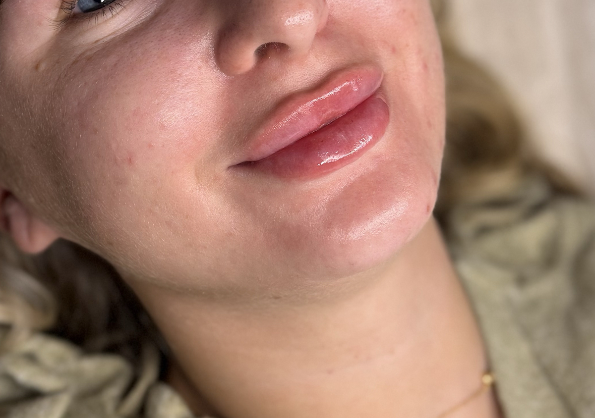 Lip filler October promo  (1/2)