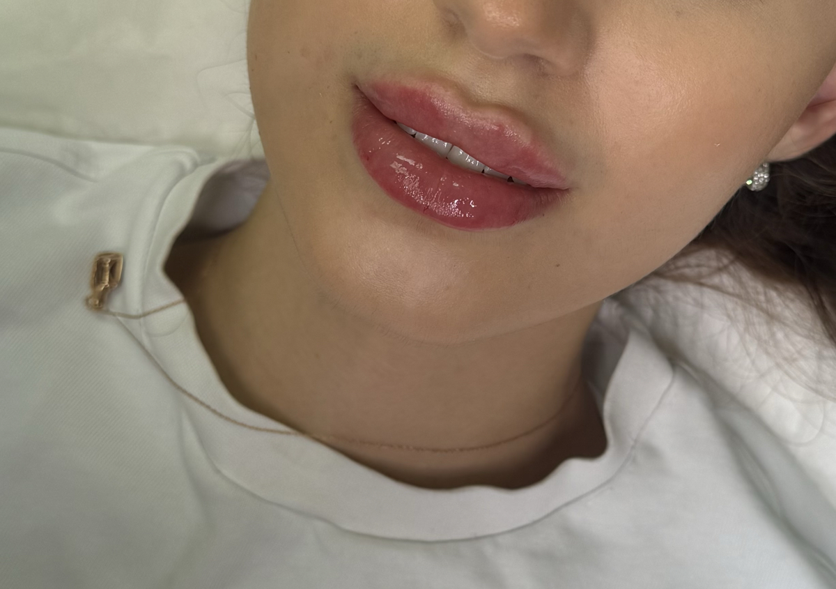 Lip filler - Juvederm