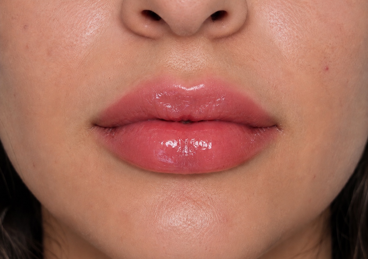 Lip filler (Full syringe)