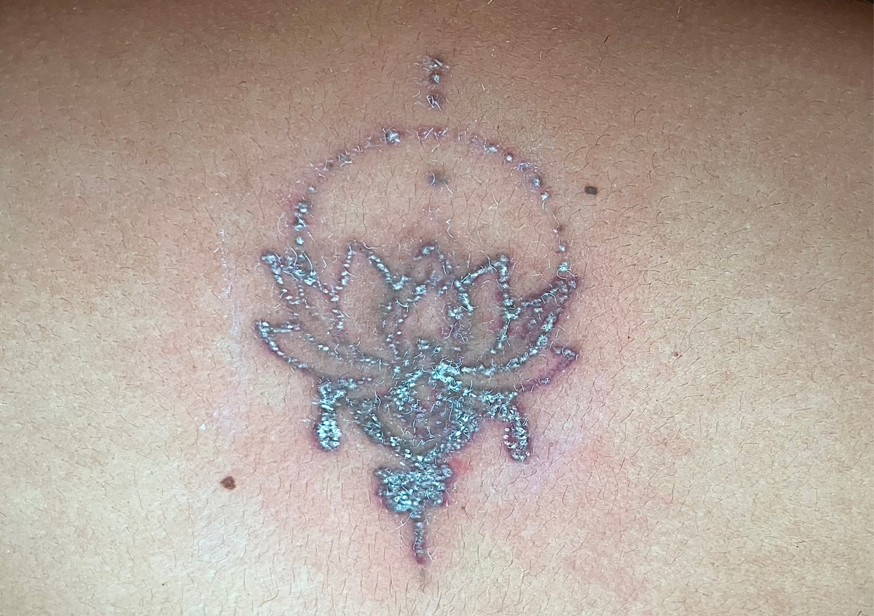 𝐒𝐦𝐚𝐥𝐥 𝐓𝐚𝐭𝐭𝐨𝐨 𝐑𝐞𝐦𝐨𝐯𝐚𝐥