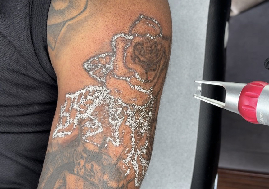 𝐌𝐞𝐝𝐢𝐮𝐦 𝐓𝐚𝐭𝐭𝐨𝐨 𝐑𝐞𝐦𝐨𝐯𝐚𝐥