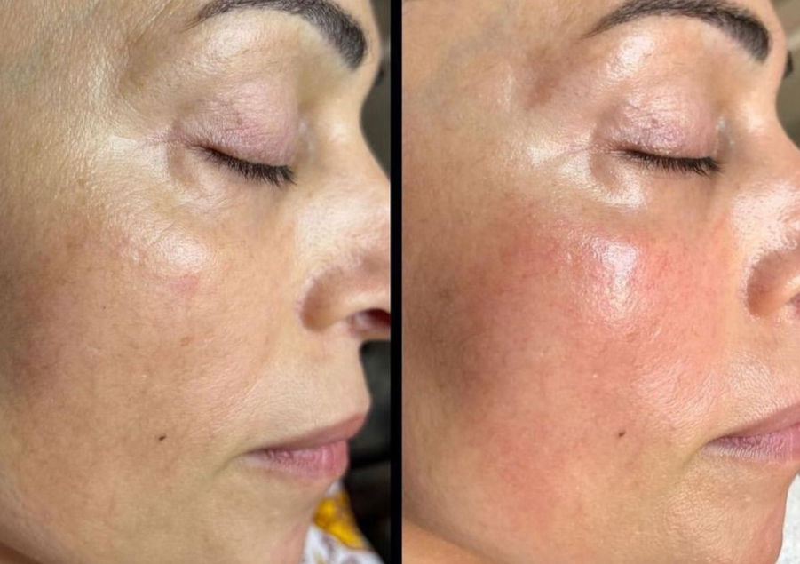Better Than Botox Facial