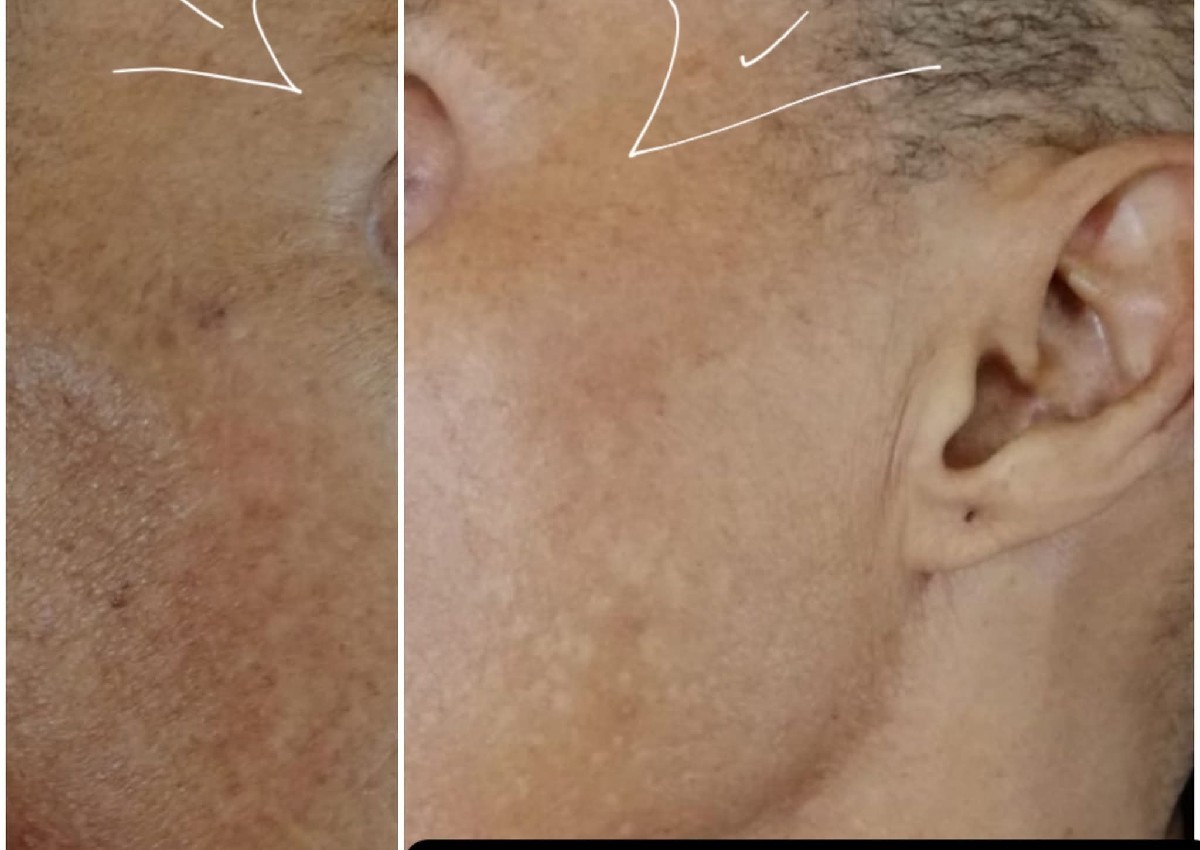 Derma rolling  (2/3)