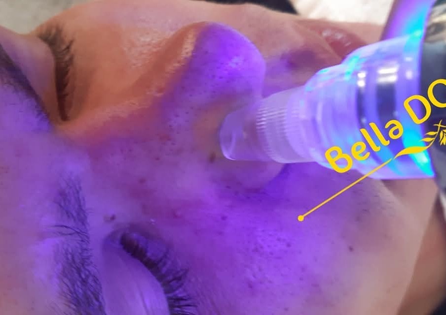Diamond peel dermabrasion facial Treatment  (3/5)