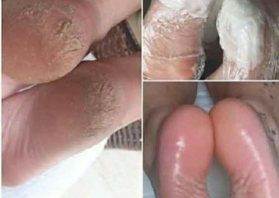 Medical foot treatment with a foot treatment  (3/3)