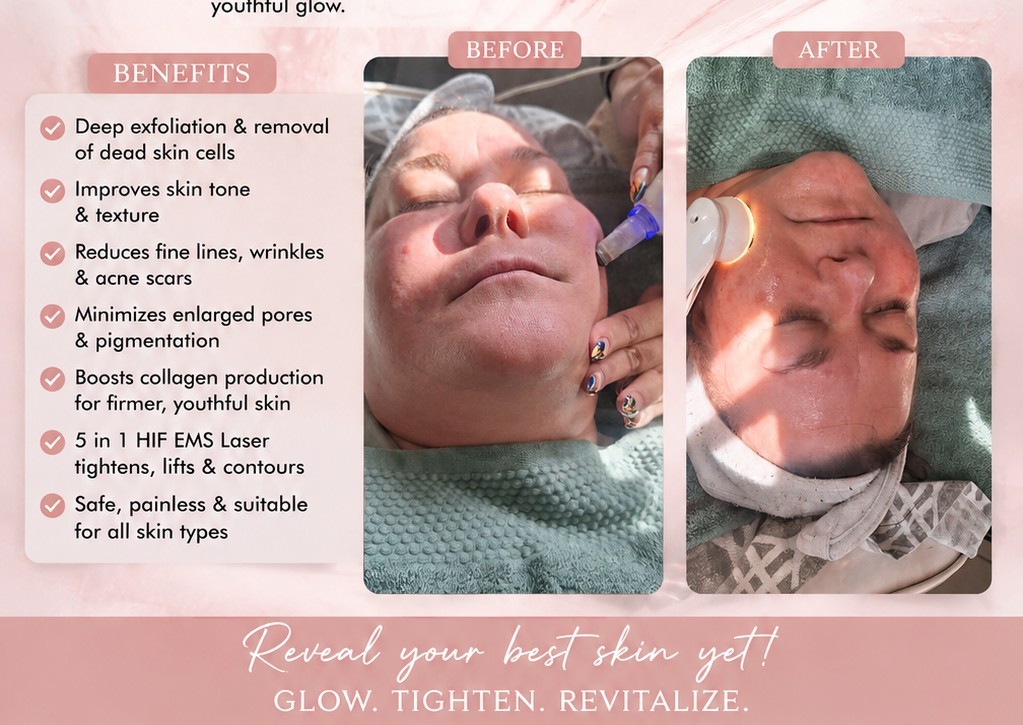 Diamond peel dermabrasion facial Treatment  (2/5)