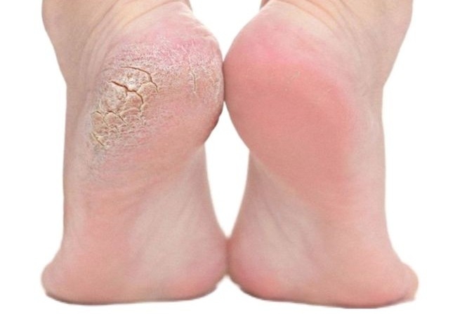Medical foot treatment with a foot treatment 