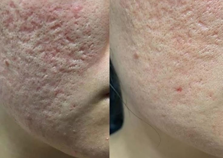 Derma rolling  (3/3)