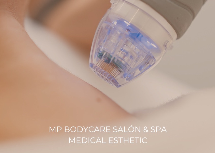 Nano RF + Microchanneling / Radiofrecuencia Nano + Microchanneling