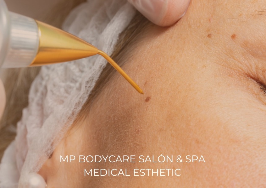 Fibroblast & Wart Removal – Eye Area / Fibroblast y Remoción de Verrugas – Área de Ojos