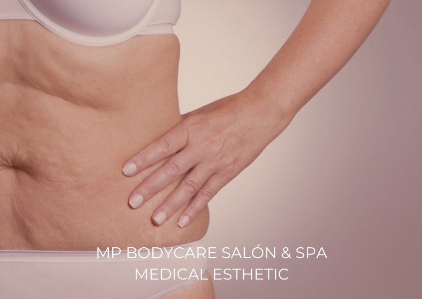 Tommy Fibroblast / Fibroblast Abdomen