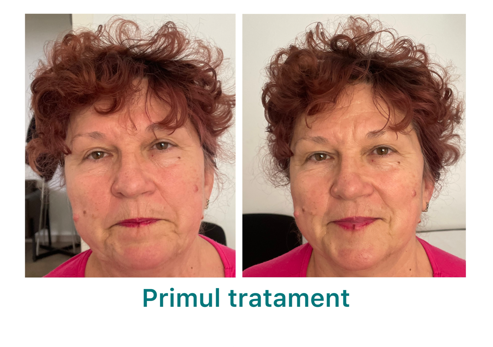 Remodelare Corporală