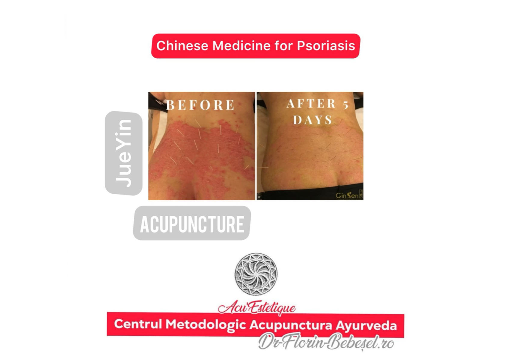 Psoriazis 15 sedinte x 1h