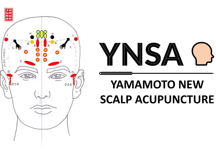 Yamamoto New Scalp Acupuncture