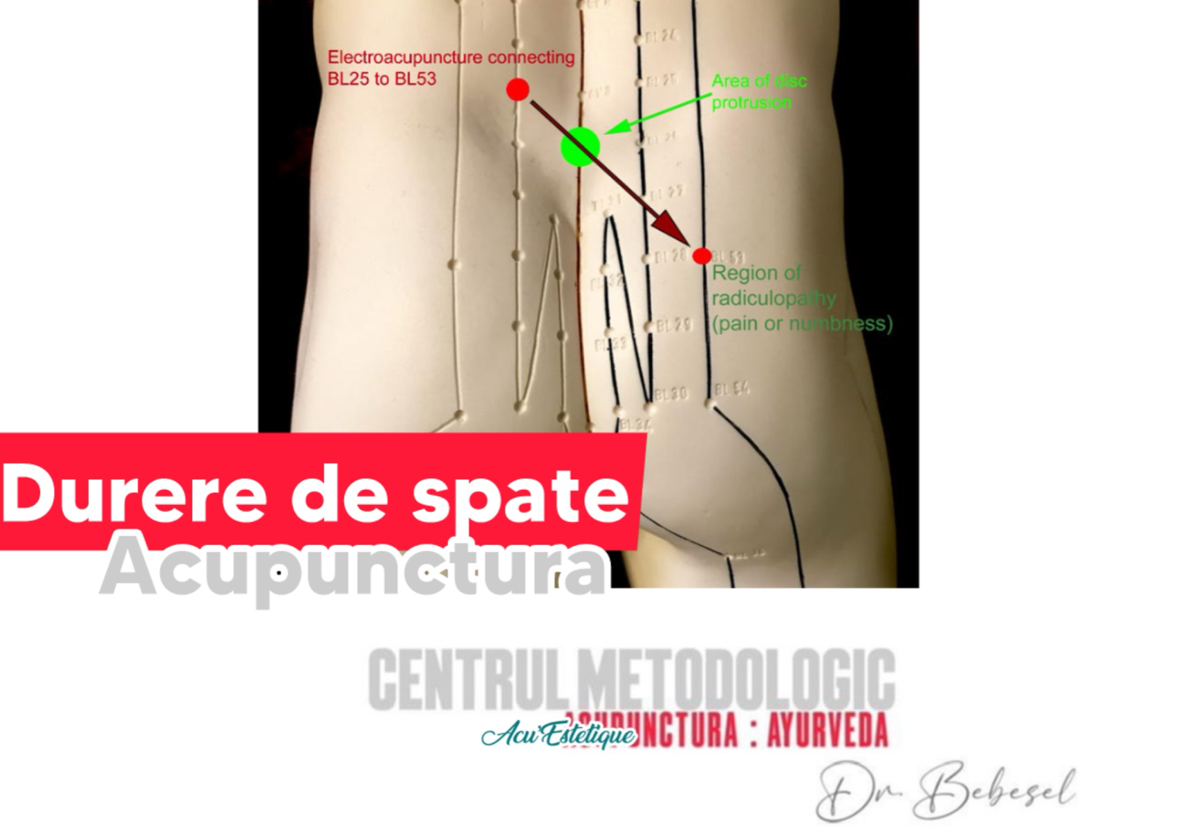 DurereDeSpate - Lombosciatica Acuta - 4 sedinte