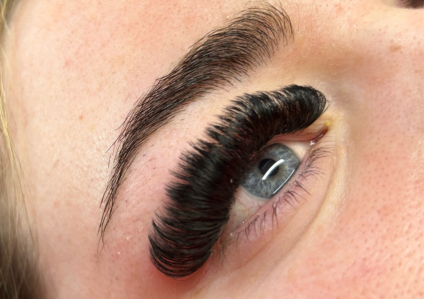 Volume infill (1-2 weeks)