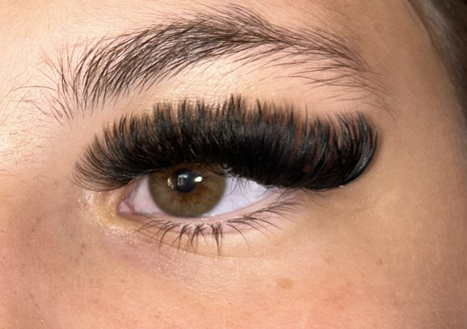 Mega volume infill (1-2 weeks) 