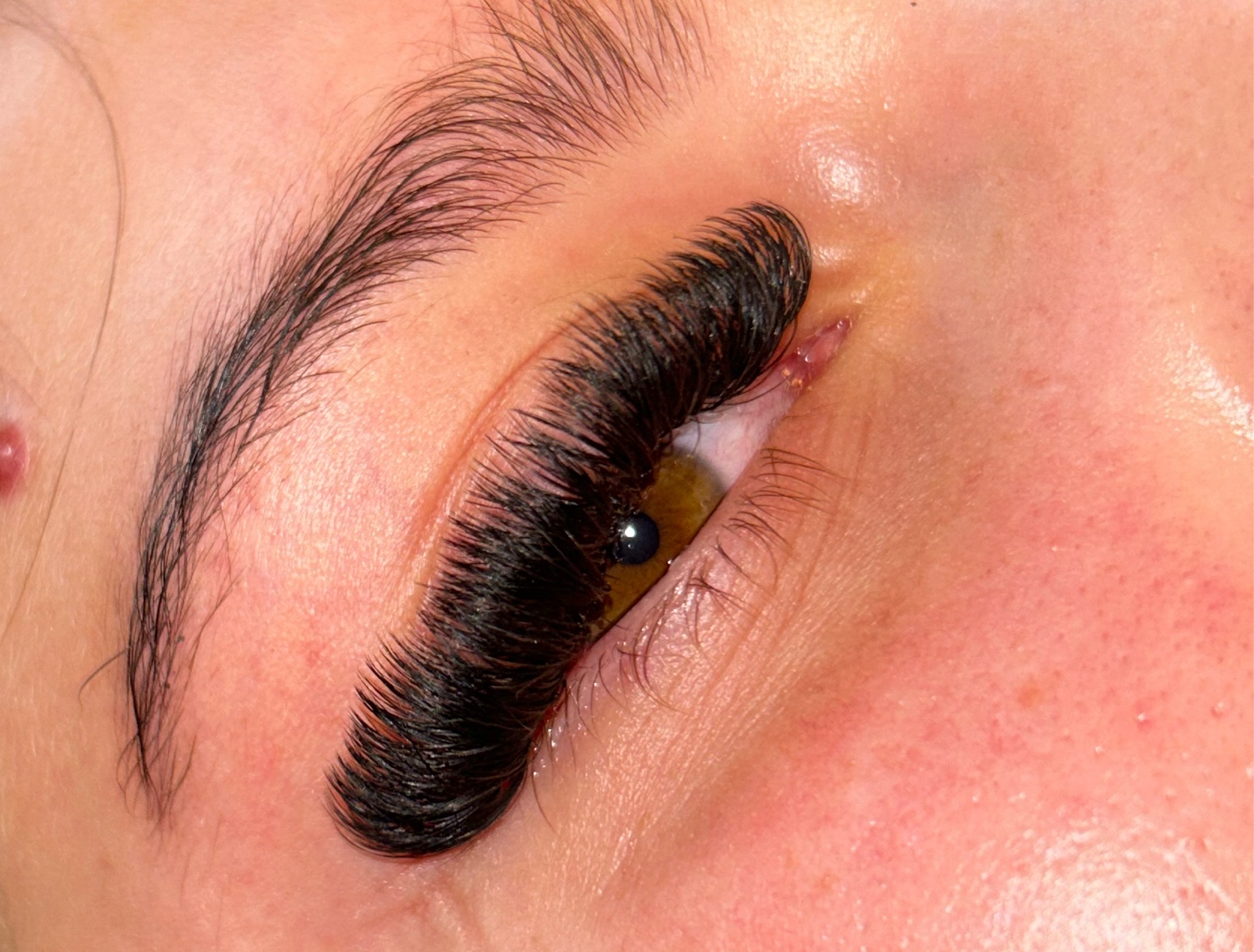 Volume infill (3-4 weeks)