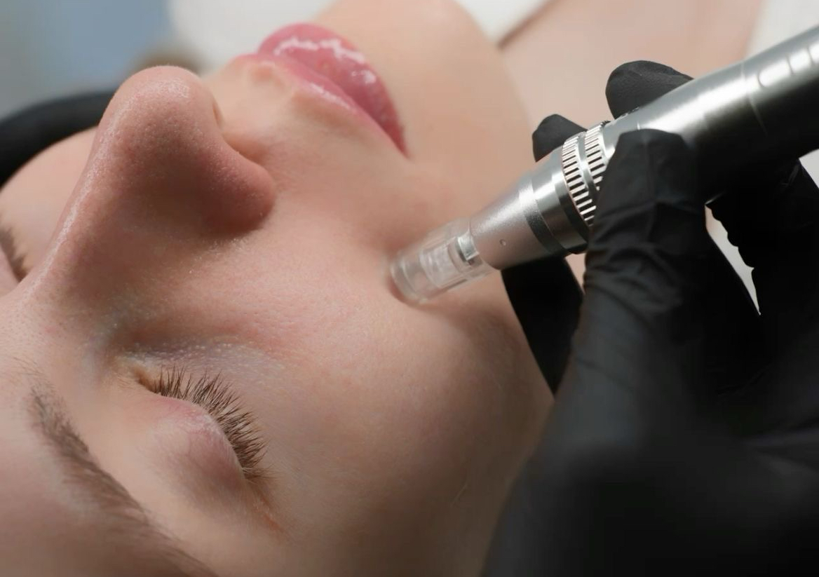 Microneedling Facial  (face only ) 