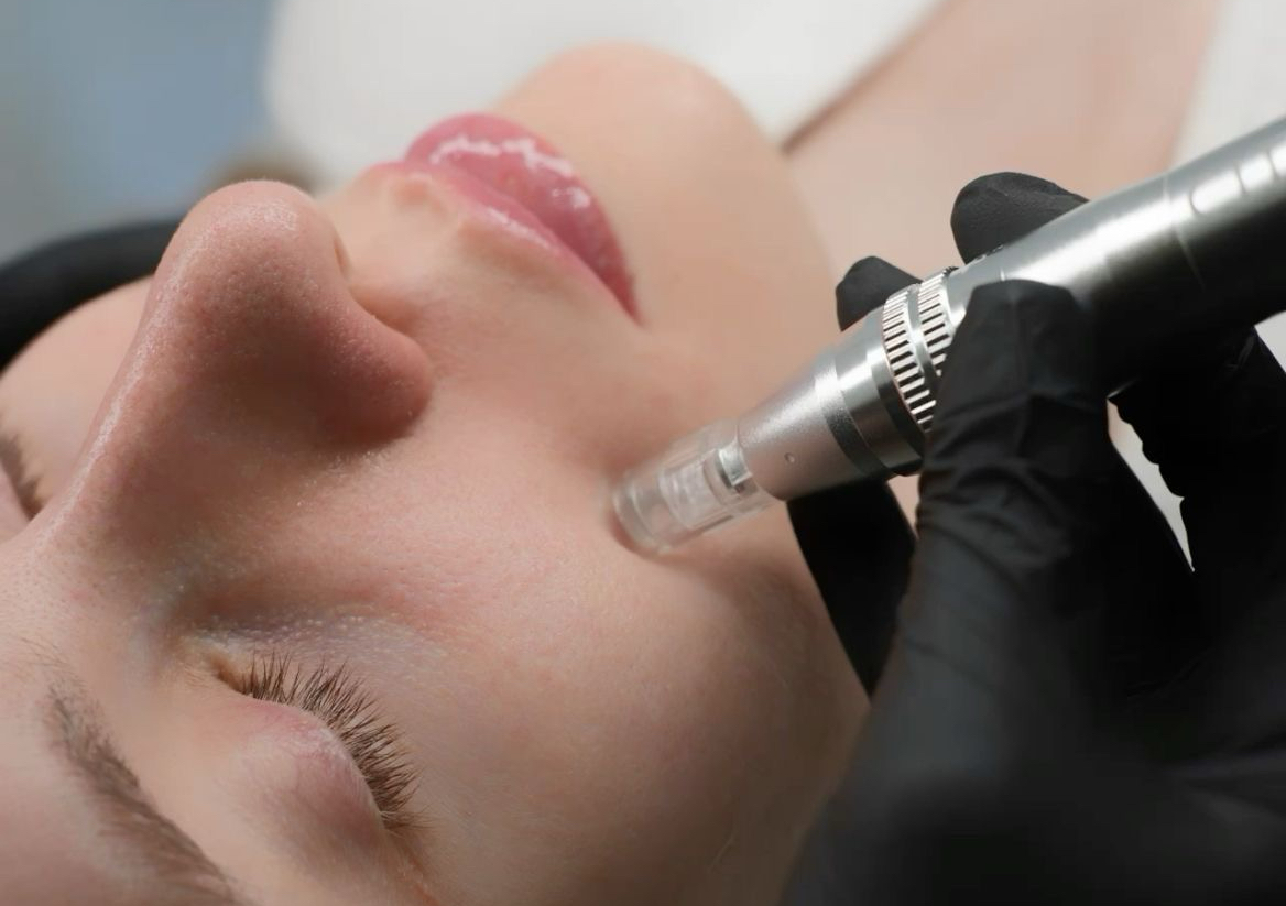 Mirconeedling (face and neck)